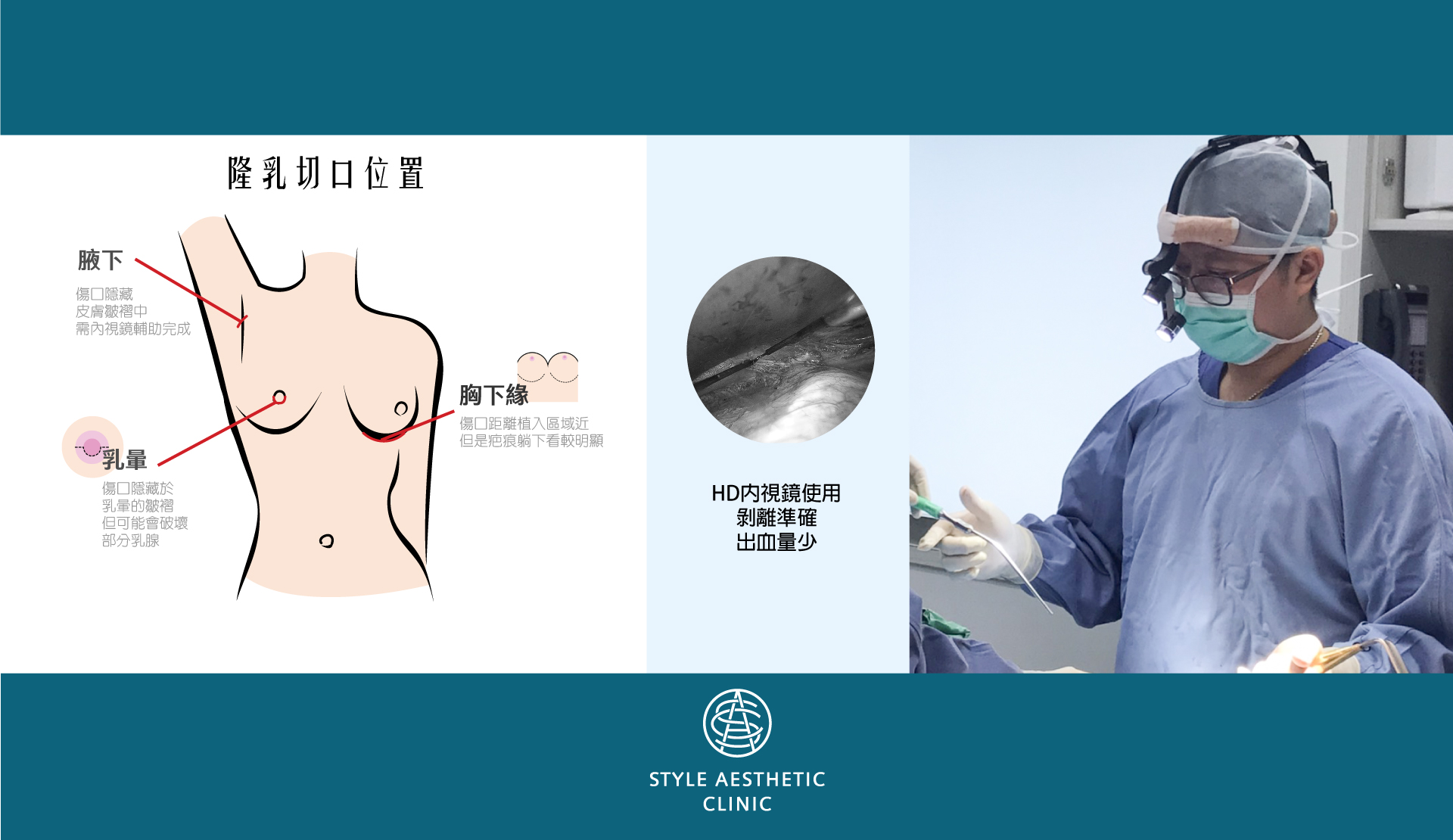 柔滴sebbin,香榭柔滴隆乳切口位置:腋下、胸下緣、乳暈