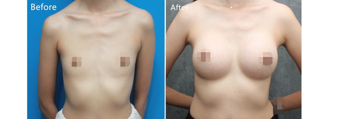 Motiva魔滴隆乳案例-風格美學