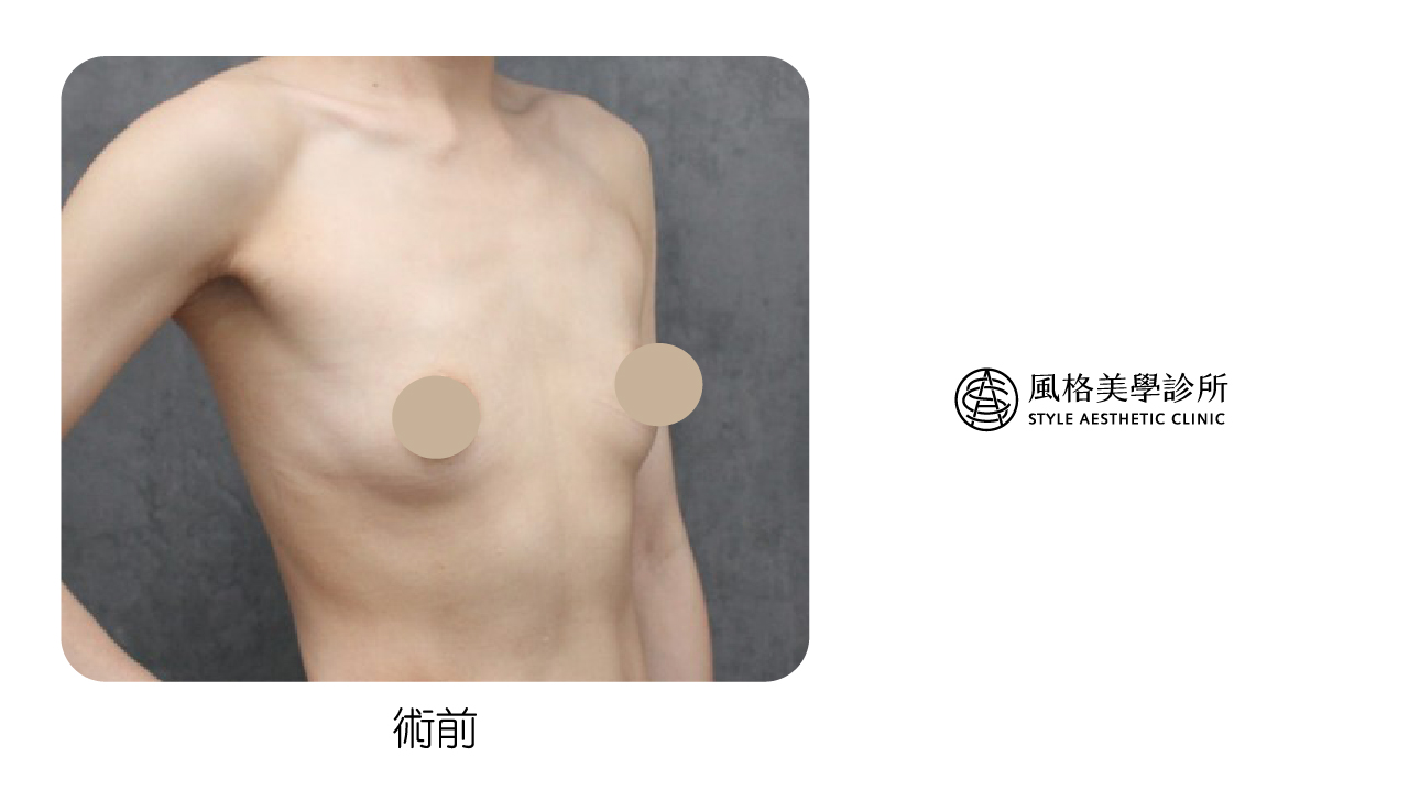 女王波術前 女王波案例-隆乳手術前