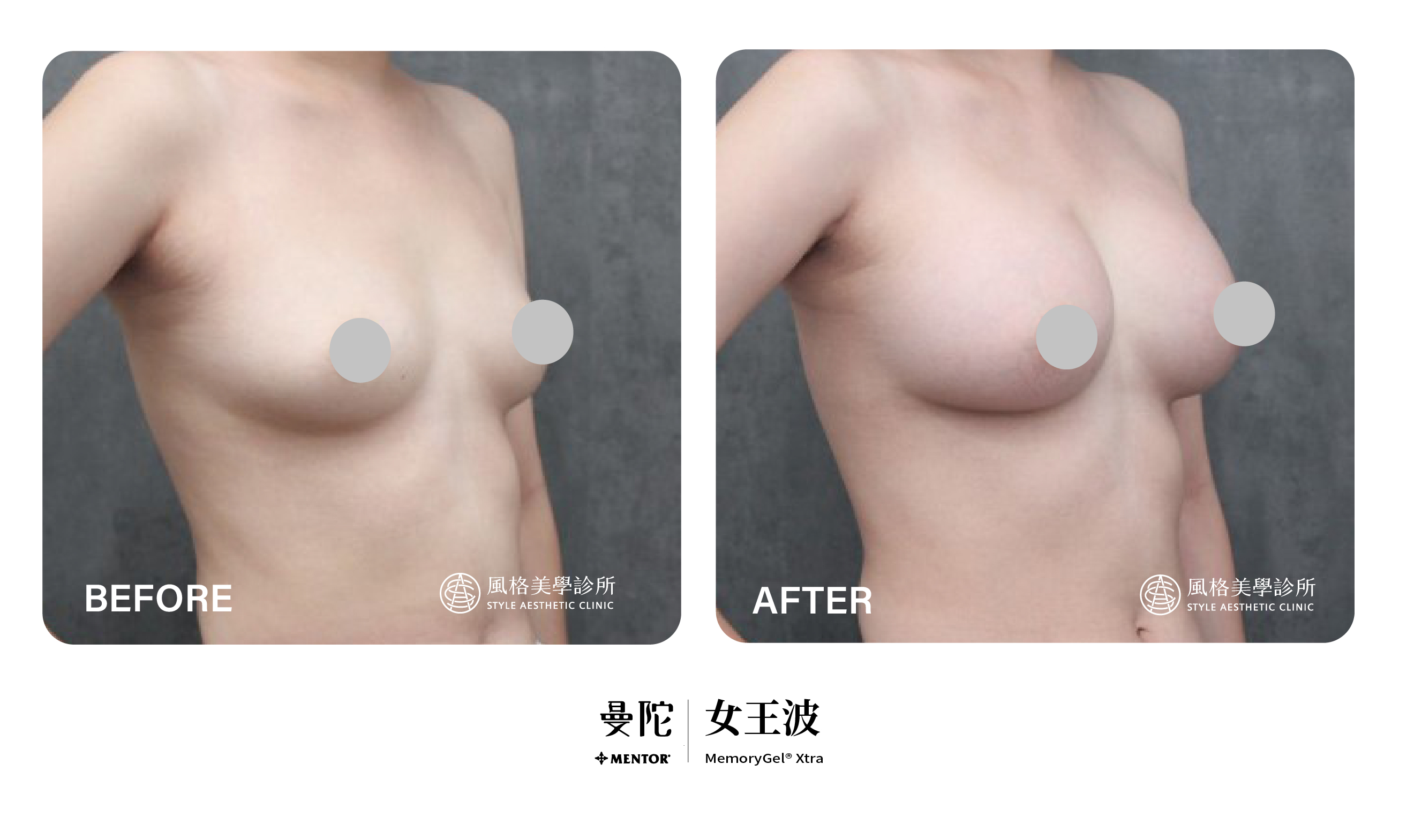 女王波術後術後照