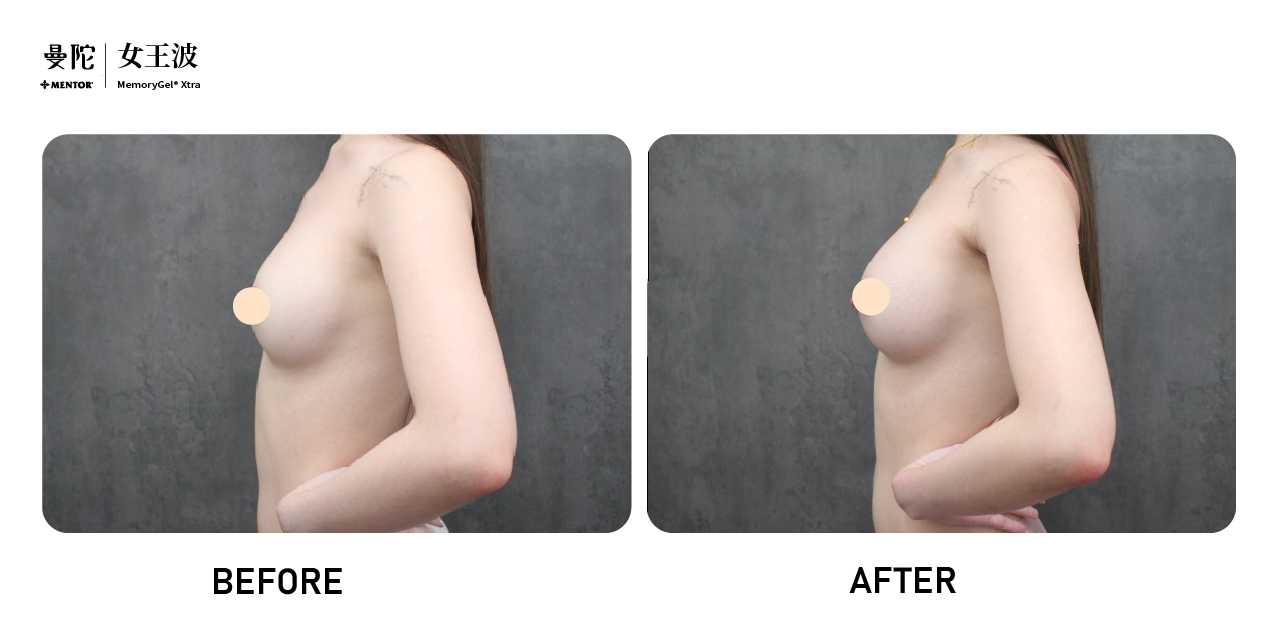 女王波隆乳術前術後照(風格美學診所)