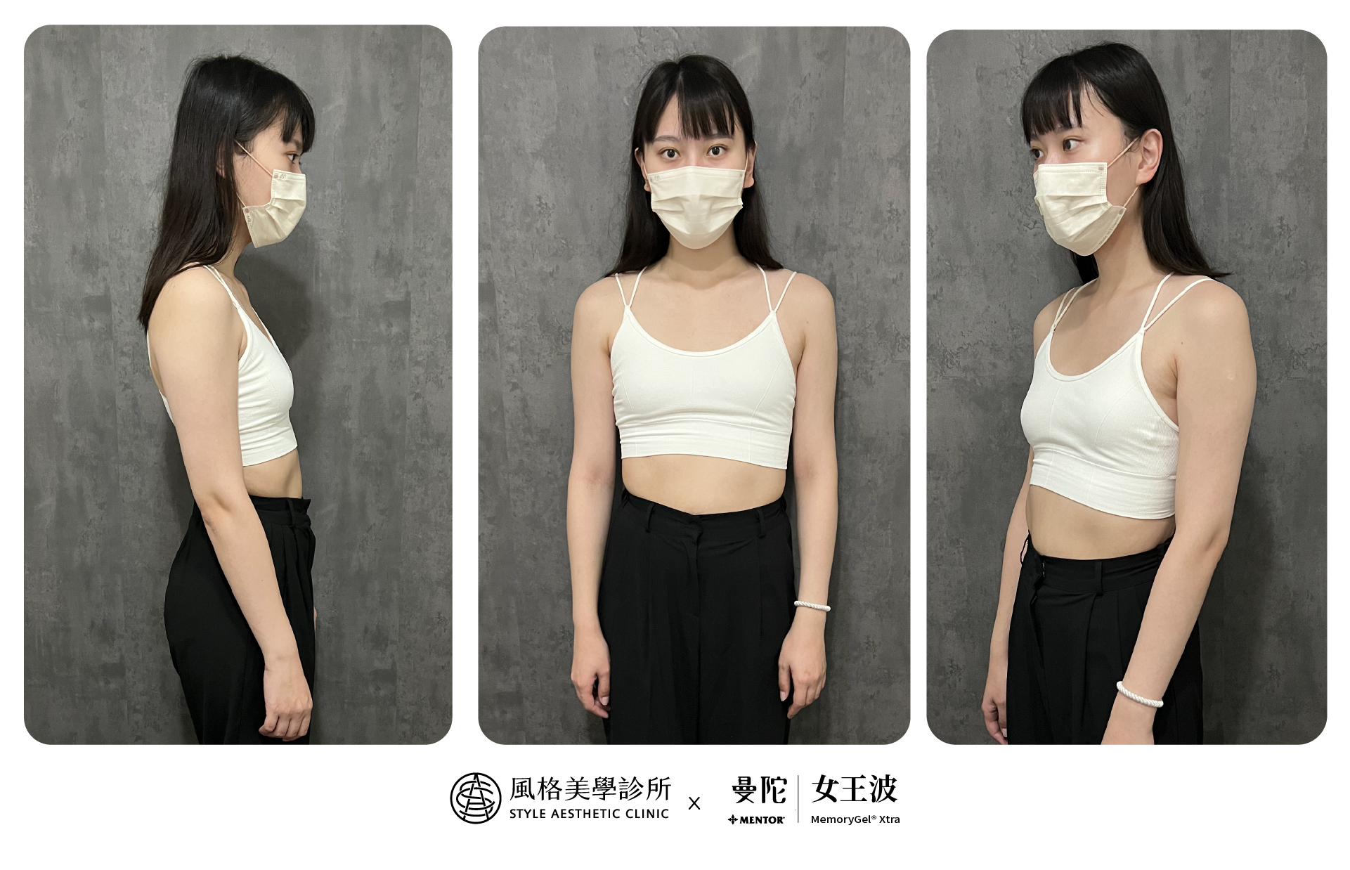 女王波隆乳術前 【女王波隆乳】從小A升級到D 把自信變得具體