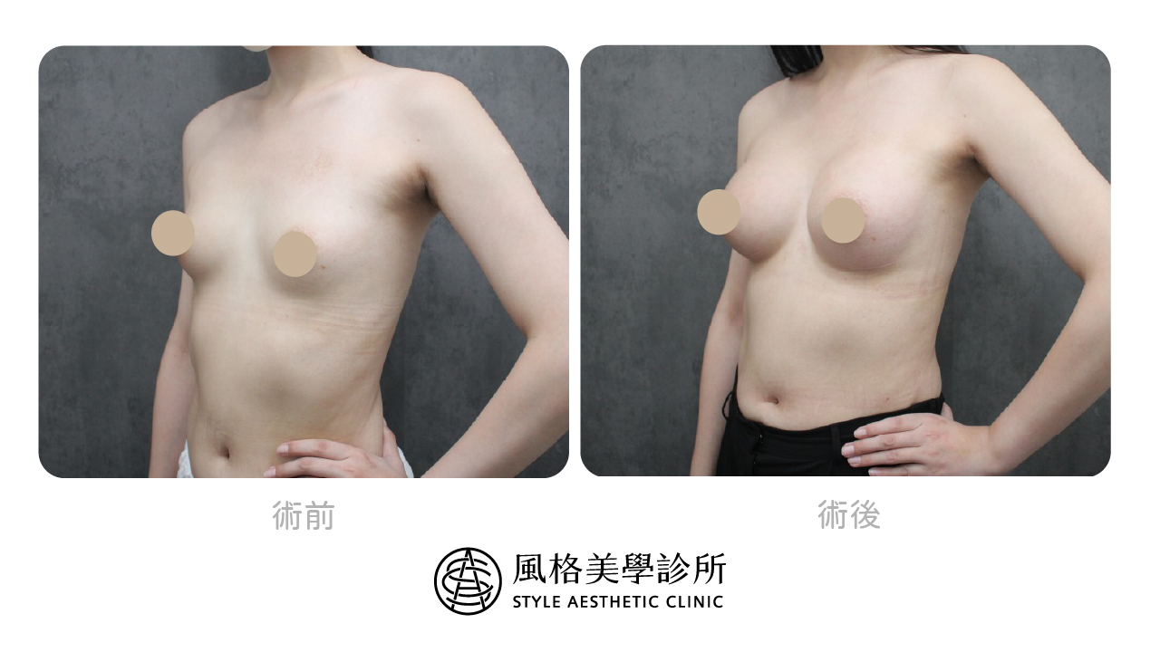 【女王波隆乳】從小A升級到D心得分享