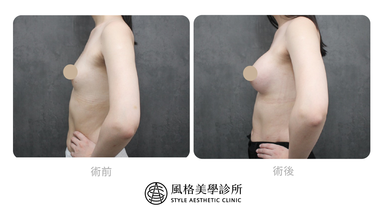 女王波隆乳從小A升級到D術後術後照-風格美學所 