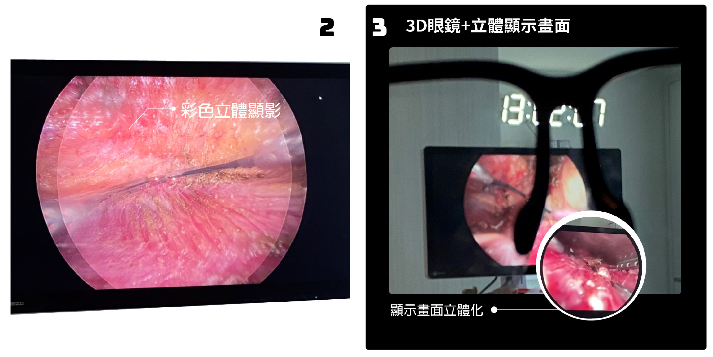 魔滴2.0 3D內視鏡隆乳