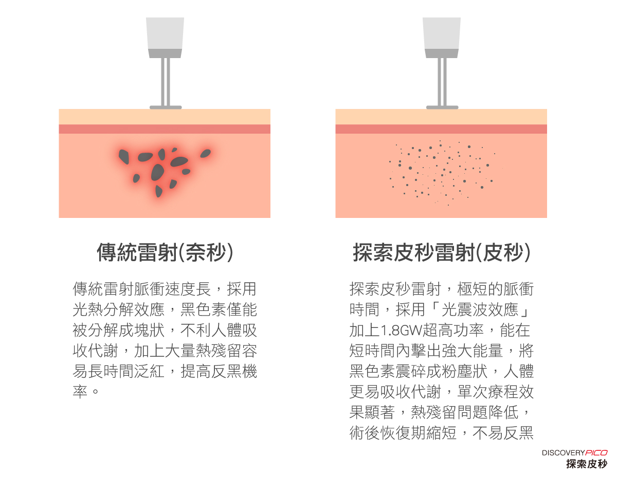 皮秒雷射與傳統雷射比較