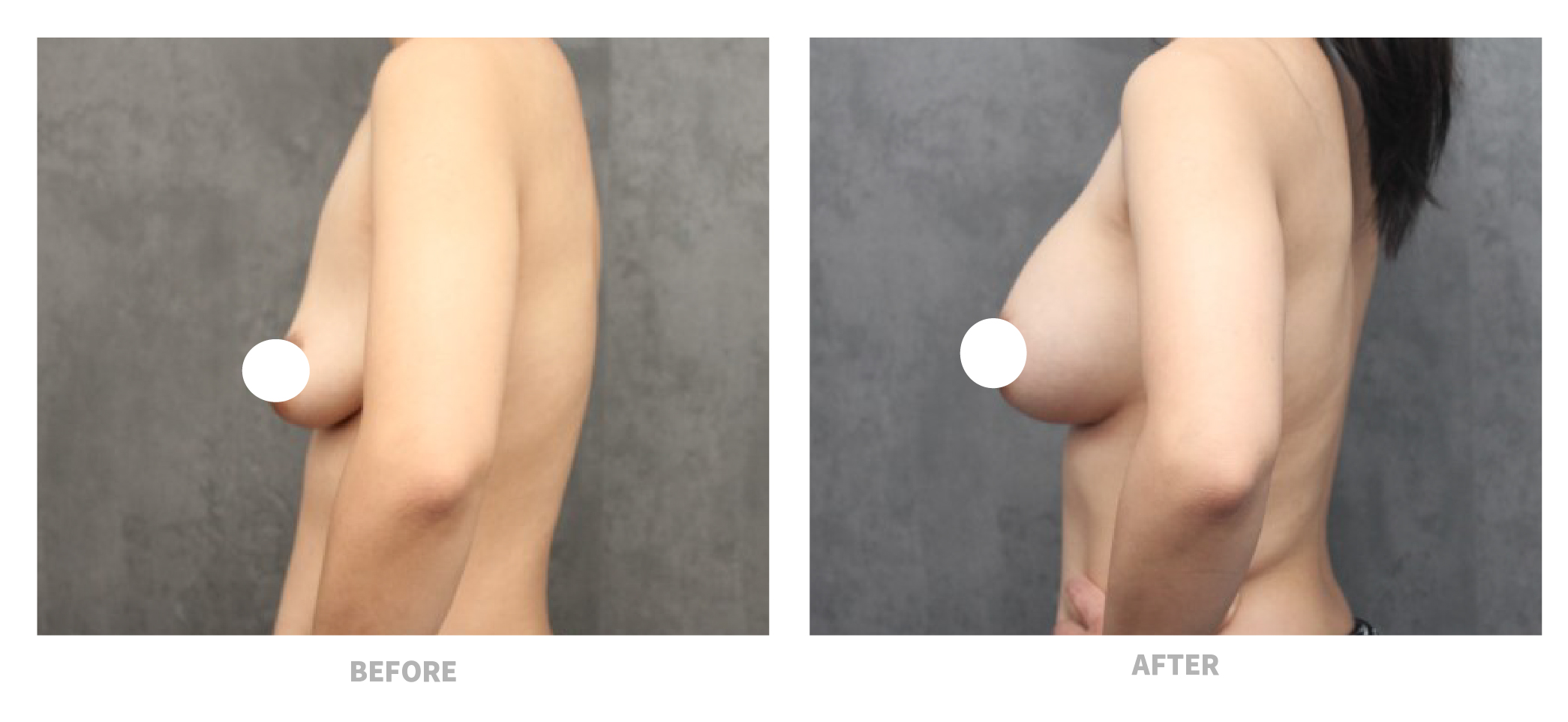 motivajoy隆乳術前術後